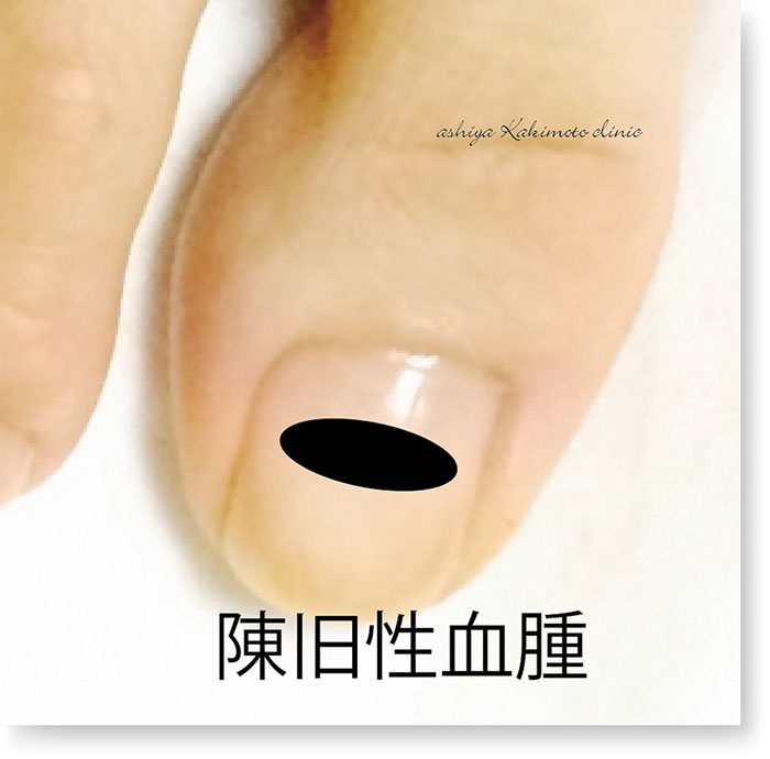 足・爪の疾患・陳旧性血腫
